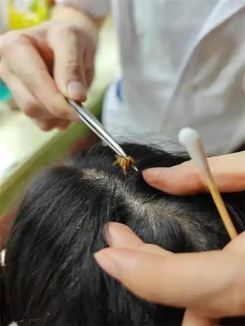中医蜂疗:自然的馈赠与未来的方向 中医蜂疗:自然的馈赠与未来的方向