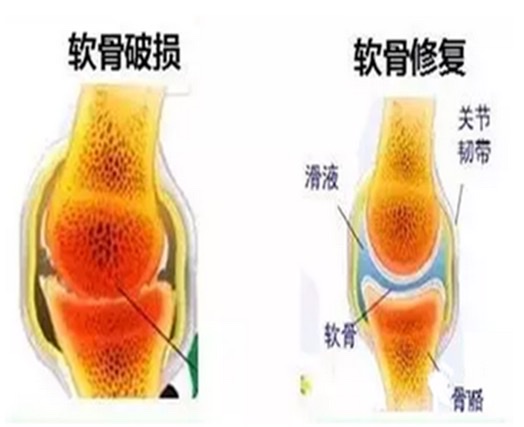聚焦中老年人骨关节疾病:探寻氨糖补充的奥秘 聚焦中老年人骨关节疾病:探寻氨糖补充的奥秘