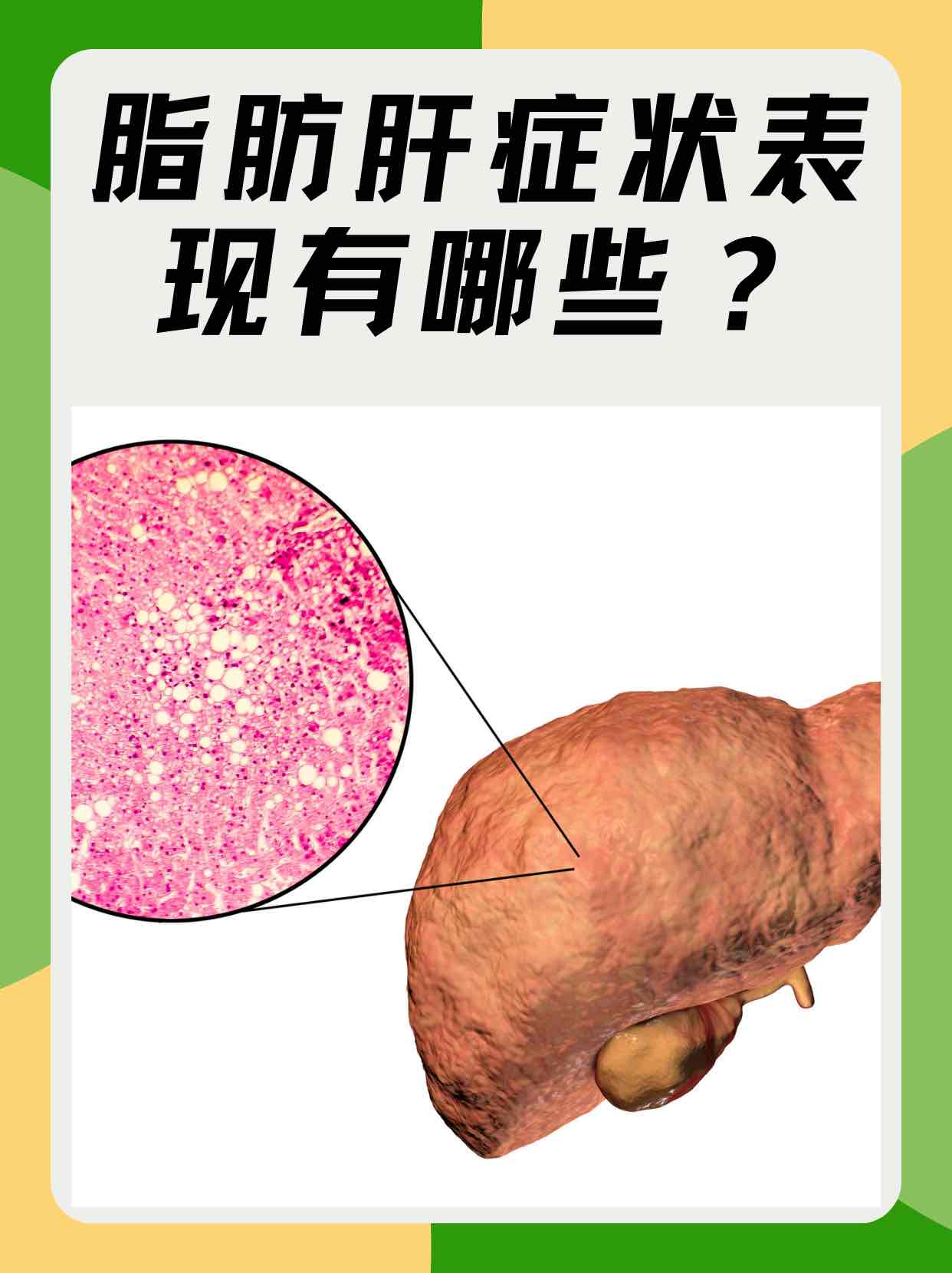老年人脂肪肝患者注意:少喝酒只是基础,多吃这几类食物更护肝 老年人脂肪肝患者注意:少喝酒只是基础,多吃这几类食物更护肝