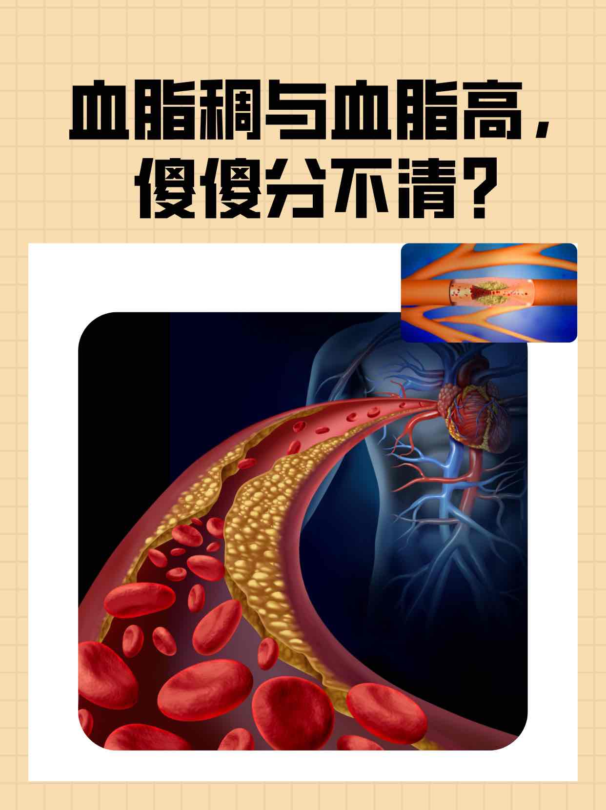 老人注意!血管里若“积了油”,身体会发信号,别等堵了才着急 老人注意!血管里若“积了油”,身体会发信号,别等堵了才着急