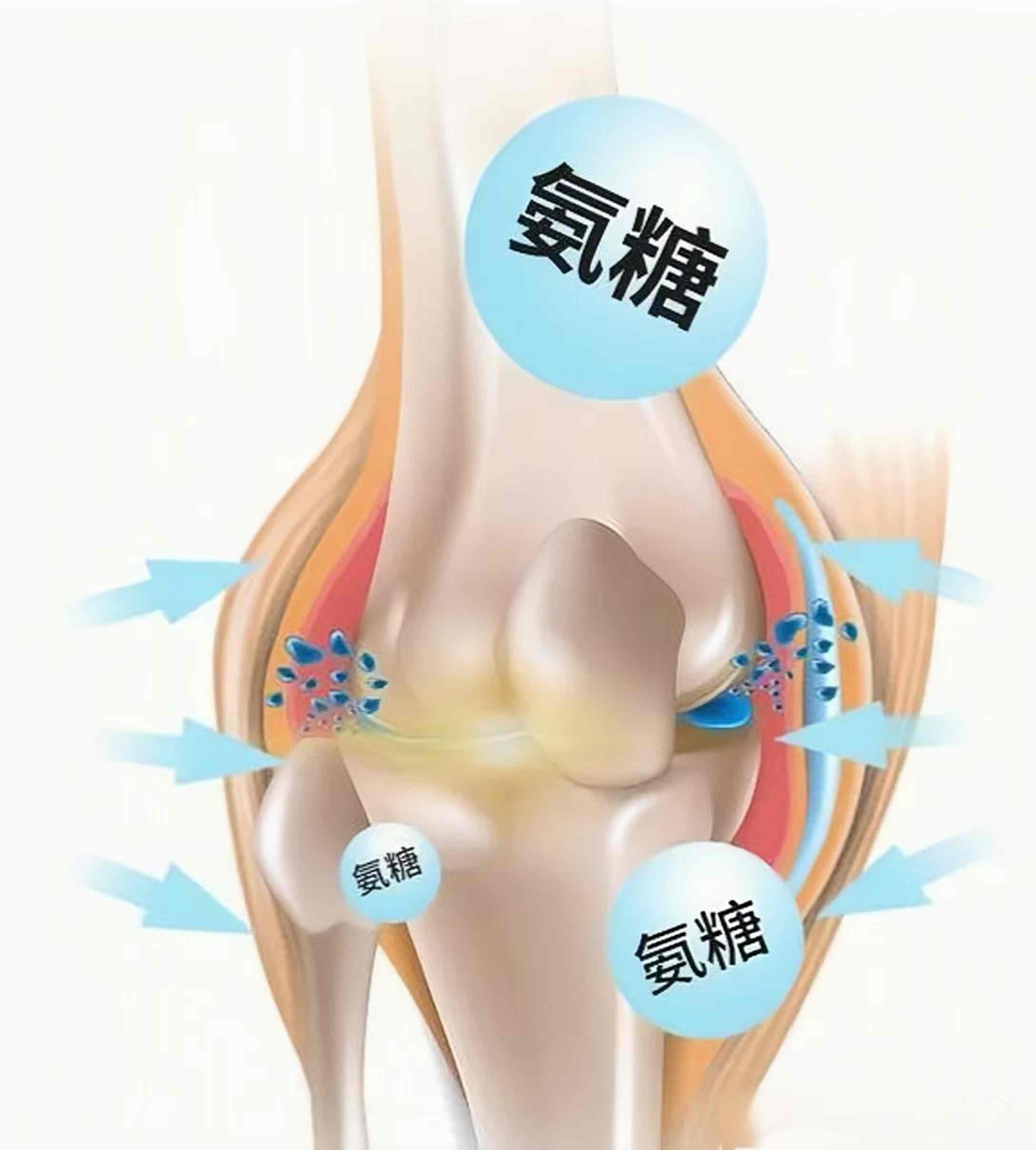 氨糖的巧搭配:骨关节炎改善新思路,修复止痛一步到位 氨糖的巧搭配:骨关节炎改善新思路,修复止痛一步到位
