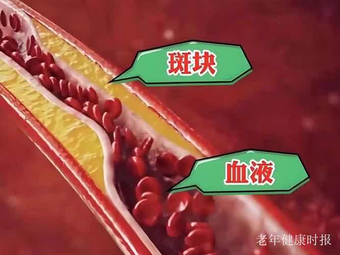 查出血管斑块别慌!做好这几点,斑块竟能慢慢缩小甚至消失 查出血管斑块别慌!做好这几点,斑块竟能慢慢缩小甚至消失