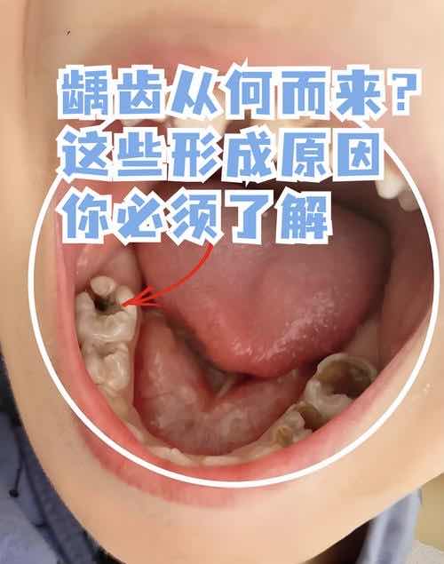 上了年纪牙缝变大?科学处理食物嵌塞与根面龋 上了年纪牙缝变大?科学处理食物嵌塞与根面龋